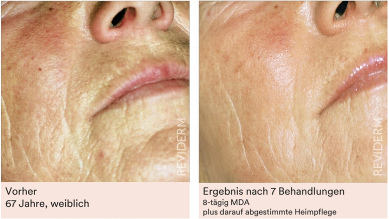 Vorher-Nachher: Ergebnis nach 7 Behandlungen, 8-tägig MDA plus darauf abgestimmte Heimpflege (67 Jahre, weiblich)