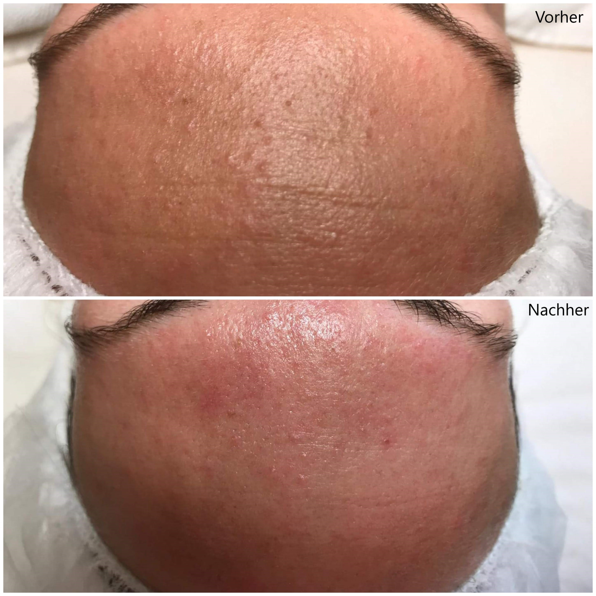 Vorher-Nachher: Stirn nach der Mikrodermabrasion-Behandlung