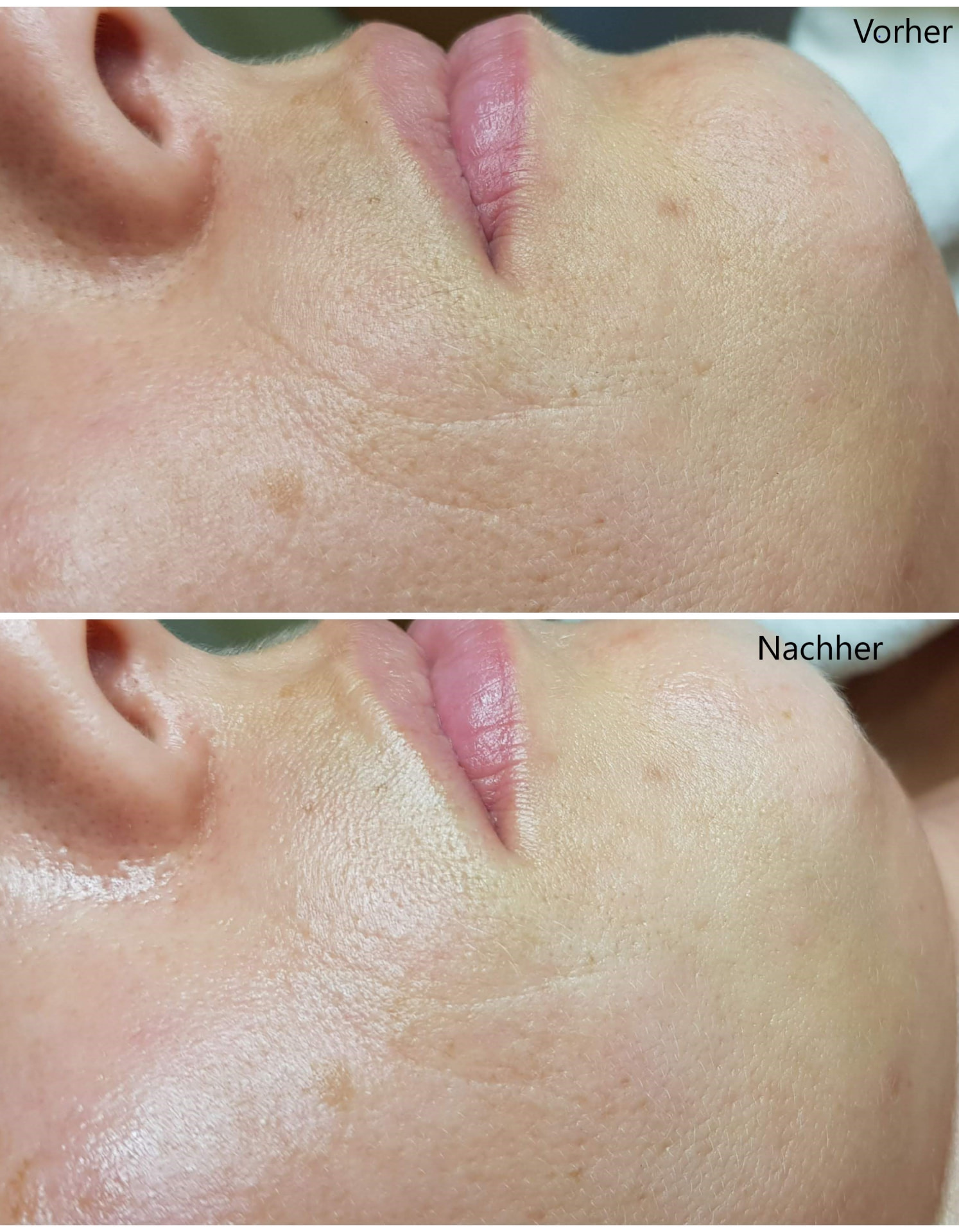Vorher-Nachher: Wangen- und Kinnbereich nach der Mikrodermabrasion-Behandlung